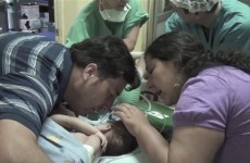 Conjoined baby girls separated in Chile